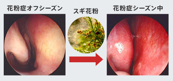 アレルギー性鼻炎 ファンデーション 販売